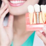 The Ultimate Guide to Dental Implants: Restoring Your Smile and Confidence